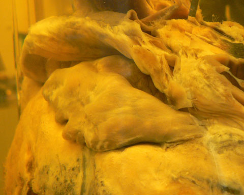 This close-up of the heart shows where conservators have repaired torn tissue. The heart is very vulnerable to movement and vibrations, and great care must be taken when moving it.