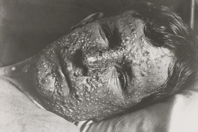 portrait of man lying in bed, his expressionless face thickly covered in pustules.