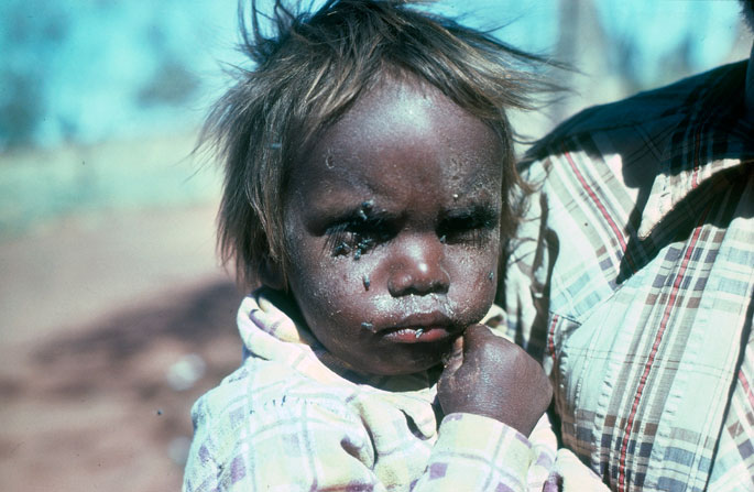 A young Aboriginal chilld with flies on their eyes and face. The child has a closed fist and is held by a partially visible adult. - click to view larger image