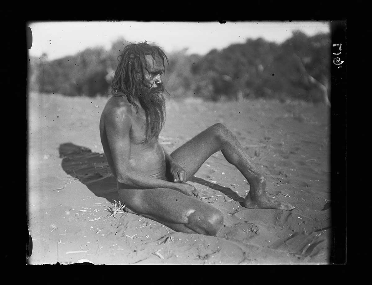 Arrernte man with badly united fracture on his left leg, Henbury station, Northern Territory 1920. He sits on the ground facing the right of the image. His right leg is tucked up under him; his left leg is extended and bent at the knee. The fracture is just above the ankle. Improper healing has left his lower leg with a permanent backward bend. His left foot rests flat on the ground as though he were standing up. - click to view larger image