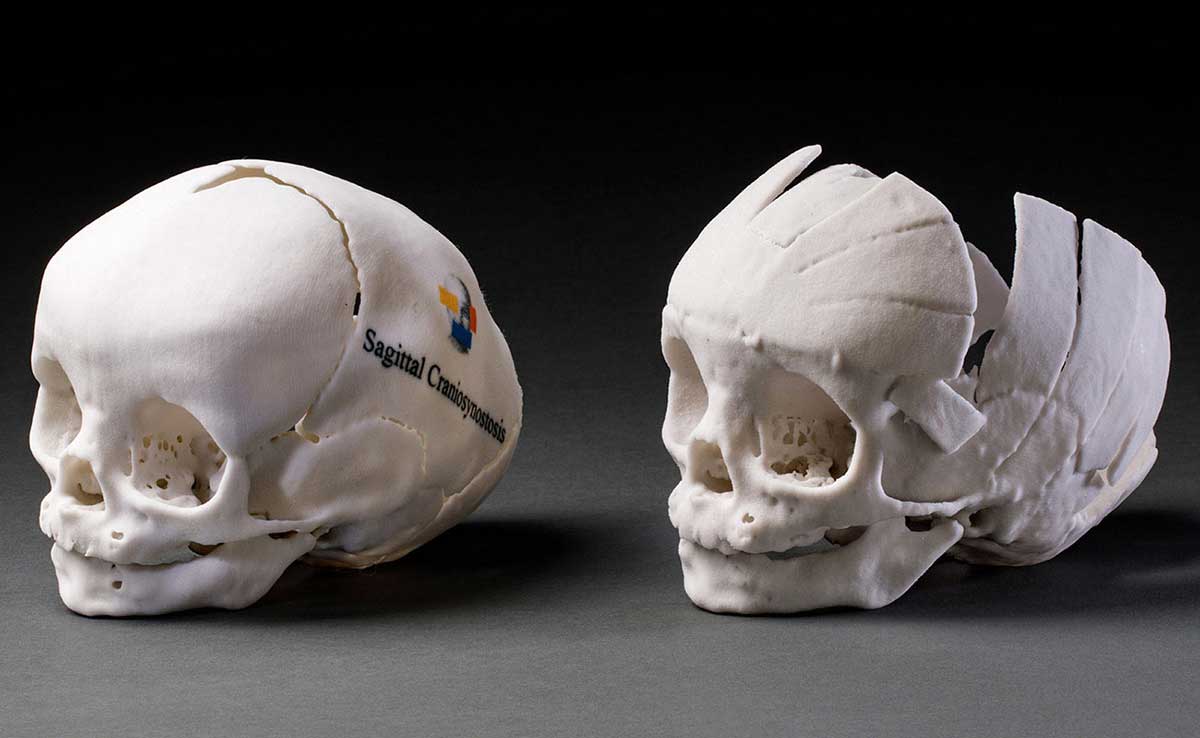 A 3D printed child's skull made from white nylon. The skull is elongated length ways and has text printed on the side that reads 'Sagittal Craniosynostosis' with a logo that features a head with three coloured rectangles in front of it. The rectangles are yellow over the proper right eye, blue over the mouth and red over the proper left ear. There is glue across the back of the skull.