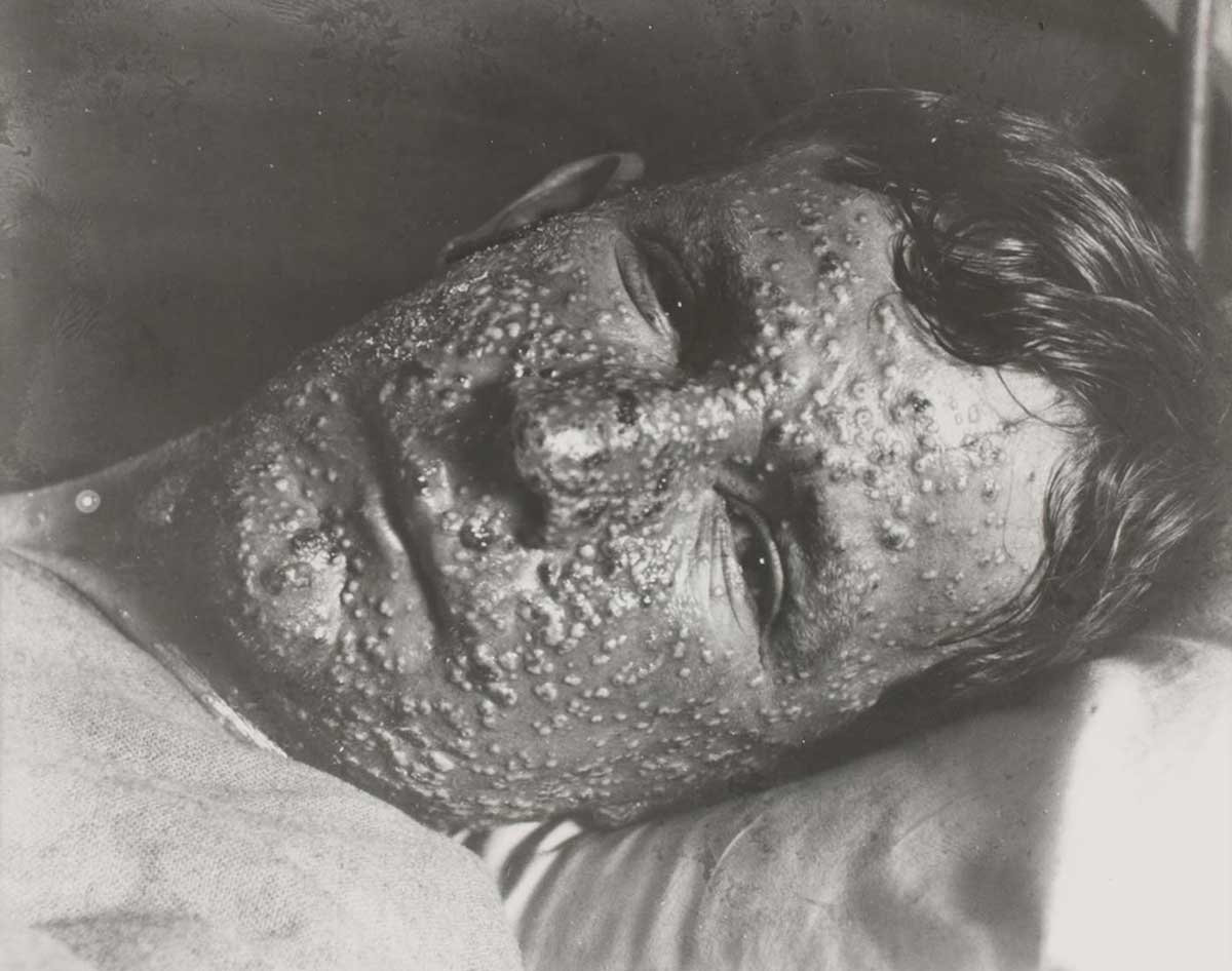 Portrait of man lying in bed, his expressionless face thickly covered in pustules.